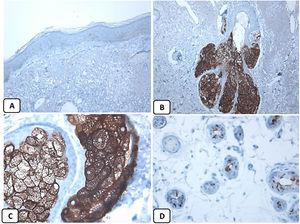 Immunohistochemical expression of EMA in the normal skin. Negative EMA staining in the epidermis (A, ×200), strong EMA expression in the cytoplasm of mature sebaceous glands (B, ×200 and C, ×400). D: positive EMA in the luminal membrane and canaliculi of sweat gland and the outer layer of sweat duct (D, ×200).