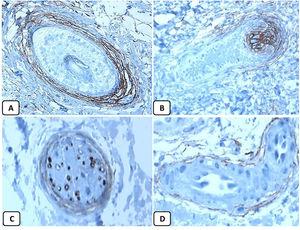 Immunohistochemical expression of CD10 in the normal skin. Positive cytoplasmic CD10 in peri-adnexal mesenchymal spindle cells (A, ×400), hair papilla of vellus follicles (B, ×400). Some nerve axons (C, ×400), and myoepithelial cells of the sweet glands (D, ×400).