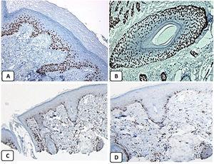 Immunohistochemical expression of p63, and BCL 2 in the normal skin. p63 nuclear positivity in the basal and some suprabasal epidermal cells (A, ×400) and cells of the external root sheath of the hair follicles (B, ×400). Positive BCL-2 expression in the basal keratinocytes in the epidermis and the keratinized outer root sheath of the isthmus and infundibulum of the hair follicle (C, ×200 and D, ×400).