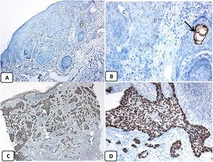 Immunohistochemical expression of EMA and p63 proteins in basal cell carcinoma. (A and B) Negative EMA in BCC except in the areas with squamous differentiation (arrow) (A, ×200 and B, ×400). (C and D) Diffuse strong nuclear positivity of p63 in the BCC (C, ×100 and D, ×400).