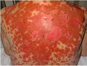 Toxic epidermal necrolysis-type acute cutaneous lupus erythematosus. Poorly defined coalescent erythematous erosions and macules, as well as scaling of the skin on the back.
