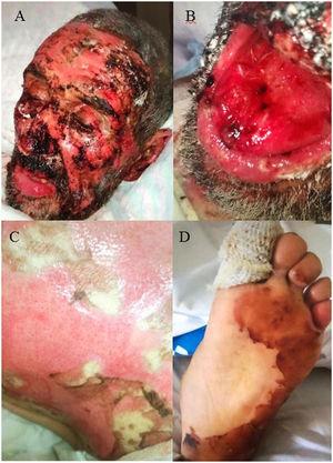 Severe mucocutaneous involvement with peeling skin and the formation of erosions and scabs. (A) Facial area. (B) Oral mucosa. (C) Back. (D) Sole of foot.