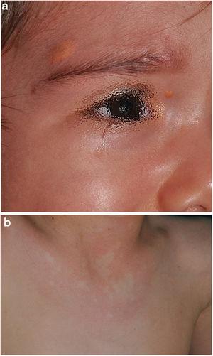 (a) Two JXGs are seen in the facial region of a 2-year-old girl who only presented CALMs and ephelides. Genetic testing confirmed the diagnosis of NF1. (b) A mottled NA greater than 10cm can be seen on the chest and neck of a 14-year-old male.