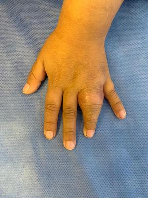 Foto frente de mano izquierda que evidencia tumefacción de 4.° dedo de mano izquierda asociada con eritema e impotencia funcional.