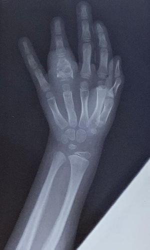 Radiografía frente de mano izquierda donde se evidencian lesiones osteolíticas en la falange del 4.° dedo.