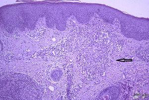 Biopsia cutánea que muestra epidermis con acantosis irregular e hiperqueratosis ortoqueratósica. Dermis superficial y media con la imagen de un granuloma epitelioide (flecha). (H&E, 100X).