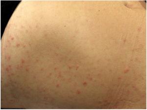 Papular rash on the abdomen.