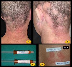 A and B, Eczematous rash on the neck. C, Minoxidil 1% and 5% in dimethyl sulfoxide (DMSO) prepared by the hospital pharmacy. D, Negative patch test to minoxidil 1% and 5% in DMSO on day 2. E, Positive patch test to minoxidil 1% and 5% in DMSO on day 4.