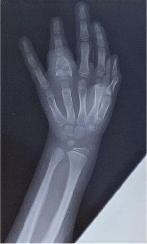 Radiograph of the left hand showing osteolytic lesions in the phalanx of the fourth finger.