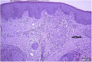 Histologic examination of skin biopsy specimen showing irregular acanthosis and orthokeratotic hyperkeratosis in the epidermis. Note the epithelioid granuloma in the superficial and mid dermis (arrow) (hematoxylin–eosin, original magnification ×100).