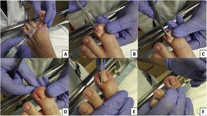 Locoregional finger blockade by infiltration of local anesthetic, mepivacaine 2% at a dose of 0.5ml/kg (A); a straight mosquito hemostat is pushed forward proximally under the nail plate to the eponychium, and 1/4 of the lateral edge of the nail plate is separated from the nail bed (B); cutting of the lateral nail plate with scissors, reaching the nail base, completing the partial onicectomy (C); final appearance of the nail bed after partial onicectomy (D); matrix cauterization with silver nitrate applied in 50mg bar (Argenpal®) on nail bed for 5–10seconds (E); final appearance after the surgical procedure (F).