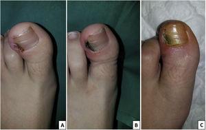 Ingrown toenail before the surgical procedure (A); clinical features immediately after the intervention (B); and 7 days after the procedure (C).