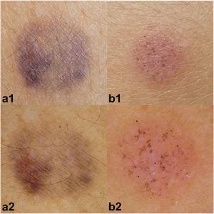 Patches with dyes. Upper row (1), clinical images; lower row (2), dermoscopic images. (a1) Negative reaction, (a2) pigment deposition with no erythema. (b1) Allergic reaction (++), (b2) diffuse and homogeneous erythema with overlying pigment.