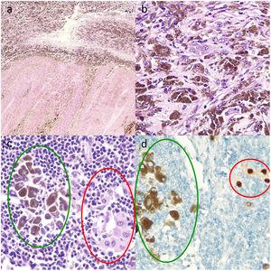 Histologic sections of lymph nodes after targeted therapy with dabrafenib and trametinib. A, Multiple melanophages against a background of fibrosis (upper part of image) and intense necrosis (lower part) (hematoxylin and eosin, original magnification ×10). B, Melanophages and viable tumor cells with abundant intracytoplasmic melanin, whose presence requires the use of additional techniques, such as staining with the nuclear marker SOX10 to assess the percentage of viable tumor cells and accordingly pathologic response (hematoxylin–eosin, original magnification ×20). C, Melanophages with intracytoplasmic melanin (green oval) and isolated viable tumor cells (red oval) (hematoxylin–eosin, original magnification ×100). D, Nuclear staining of viable tumor cells (red circle) and cytoplasmic staining of melanophages with no nuclear expression (green oval) (immunohistochemical staining with SOX10, original magnification ×100).