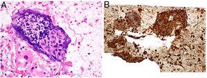 Bloque celular procedente de un carcinoma de células escamosas. A)La tinción de hematoxilina-eosina muestra la pseudoarquitectura del carcinoma de células escamosas generado por la coagulación de un aspirado. B)Tinción de inmunohistoquímica positiva para citoqueratina AE1/AE3.
