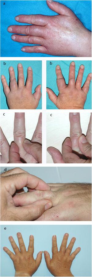 a) Caso 1. Dactilitis en las falanges proximales de los dedos primero, segundo y tercero de la mano izquierda; b) Caso 2. Dactilitis en las falanges proximales de 3 dedos de cada mano; c) Caso 3. Dactilitis en las falanges proximales del dedo medio izquierdo y del dedo índice derecho; d) Caso 4. Dactilitis en la falange proximal del dedo anular derecho, y e) Caso 5. Dactilitis en las falanges proximales de los dedos índice, medio y anular de cada mano.