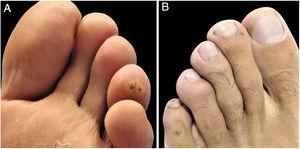 Hyperkeratotic yellow-brown (A) and small red papules (B) with dark central dots.