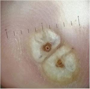 Dermoscopy revealed a white halo of hyperkeratosis and a dark central orifice surrounded by a white ovoid structure.