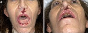 (a, b). Lesiones destructivas de la línea media inducidas por cocaína (CIMDL) con colapso de ambas fosas nasales, nariz en silla de montar y mucositis oral crónica.