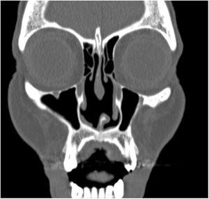 Tomografía axial de la misma paciente con CIMDL. Se observa una perforación del septo nasal.