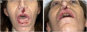 A and B, Cocaine-induced midline destructive lesions with collapse of both nostrils, saddle nose deformities, and chronic oral mucositis.