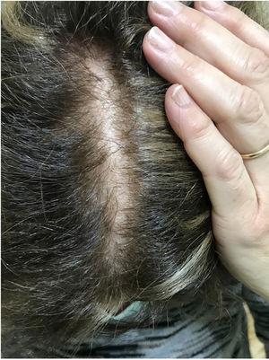 Primary sensitive scalp: healthy skin alongside androgenetic alopecia.