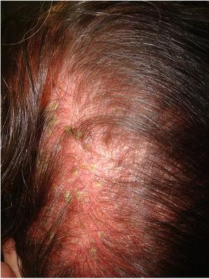 Primary sensitive scalp: erythematous skin alongside telogen effluvium.