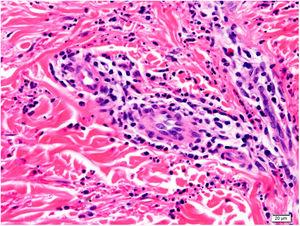 Higher magnification histological image, showing the lesion centered on the dermis with a predominantly lymphocytic infiltrate and abundant leukocytoclasia and hematic extravasation (hematoxylin–eosin staining, original magnification ×20).