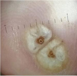La dermatoscopia reveló un halo blanco de hiperqueratosis y un orificio central oscuro rodeado por una estructura ovoide blanca.