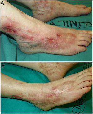 Livedoid vasculopathy (patient #1). A, Ulcers and erosions, erythema, and atrophic scars on the ankles and feet. B, Complete response after 3 months of treatment with rivaroxaban.