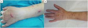 A, Two indurated erythematous nodules with a sporotrichoid distribution on the back of the hand and on the left forearm. B, Resolved lesions after treatment.