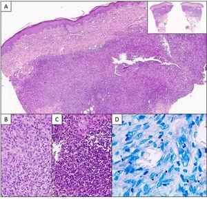 A, Histologic section showing a deep granulomatous dermal infiltrate with a nodular pattern (panoramic view in top-right corner) (hematoxylin–eosin, original magnification ×40). B, Detailed view showing a lymphocytic and histiocytic infiltrate (hematoxylin–eosin, original magnification ×200). C, Suppurative areas with abundant neutrophils and cell debris (hematoxylin–eosin, original magnification ×400). D, Ziehl–Neelsen staining. Note the long pink structures (arrows) (original magnification ×630).