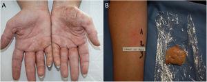 Dermatitis de contacto por proteínas a carne de pollo. A) Eccema crónico de manos. B) Resultado positivo del prick-prick con carne de pollo.