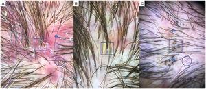 A) Foliculitis decalvante: pelos en penacho o tufted hairs (> 5 pelos emergiendo de una raíz folicular) (cuadrado), eritema difuso (flecha) e hiperqueratosis folicular o descamación tubular amarillenta (círculo). B) Detalle de pelos en penacho (cuadrado). C) Celulitis disecante del cuero cabelludo: puntos negros o «pelos cadavéricos» (cuadrado), pelos vellosos (círculo) y pelos rotos (flechas).