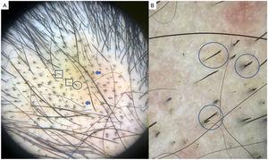 Trichotillomania. A, Black dots (arrows), twisted or tangled hairs (circle), and broken hairs of varying lengths (squares). B, Detail showing hairs of varying lengths with split ends (trichoptilosis) or hairs with tulip-shaped ends (circles).