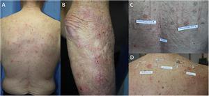 Adult atopic dermatitis aggravated by contact allergy to fragrances in a 74-year-old man. (A and B) Eczema affecting the posterior trunk and right arm. (C) Results of patch testing with the GEIDAC standard series at 48hours: fragrance mix I+++ and fragrance mix II+++. (D) Patch test results (fragrance series) at 96hours: geraniol++ and citral++. Partial control of AD was achieved with avoidance measures.
