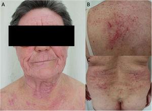 Adult atopic dermatitis exacerbated by allergic contact dermatitis caused by airborne cat dander protein. (A) Eczematous dermatitis with an airborne pattern. (B and C) Disseminated eczema on the posterior trunk, buttocks, and intergluteal cleft.