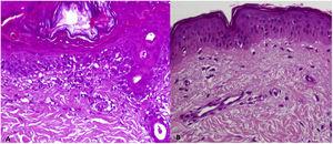 (A) Superficial lymphocytic inflammatory infiltrate with vacuolization of the basal area and necrotic keratinocytes. (B) No involvement of the dermoepidermal junction or inflammatory infiltrate.