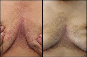 Darier disease, patient 2. (A) Pretreatment; (B) Improvement after 12 weeks of treatment with isotretinoin 30mg and diclofenac sodium 3% gel twice daily.