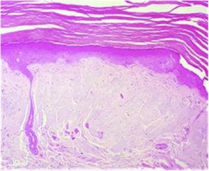 Histopatología. Se observa el depósito de material en dermis superficial. hematoxilina-eosina (H-E) ×20.