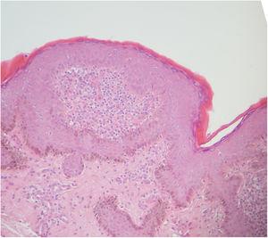 Hallazgos histológicos de la biopsia efectuada con sacabocados. Tinción de hematoxilina-eosina.