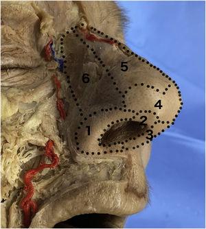 Representación de las subunidades estéticas nasales: 1. Ala nasal; 2. Triángulo blando; 3. Columela; 4. Punta; 5. Dorso; 6. Pared lateral.