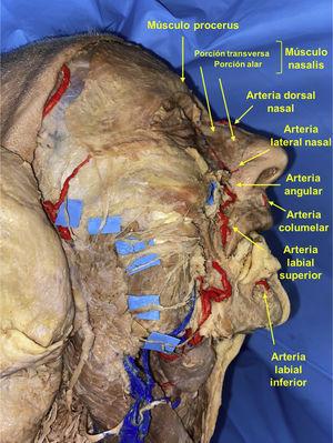Disección anatómica realizada por los autores en la que se identifican las 2 fuentes principales de irrigación de la pirámide nasal: arteria dorsal de la nariz proveniente de la arteria oftálmica y la arteria angular y sus ramas provenientes de la arteria facial. Las divisiones del nervio facial aparecen remarcadas con contraste.