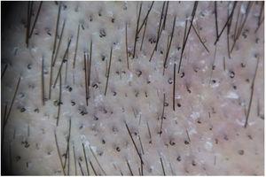 Imagen tricoscópica de pelos «en sacacorchos» típica de la tiña de puntos negros provocada por T.tonsurans.