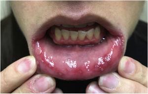 Múltiples úlceras profundas de 2 a 5 mm con base eritematosa en la mucosa del labio inferior y los bordes laterales de la lengua.