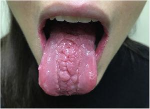 Fisuras profundas entrelazadas que proporcionan un aspecto nodular al tercio medio de la lengua, los tercios laterales de la lengua muestran un aspecto atrófico liso.