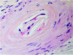 Examen histopatológico de la biopsia cutánea: grietas biconvexas con forma de aguja dentro de las arteriolas de la dermis (hematoxilina-eosina ×40).