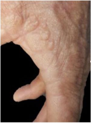 Clinical image. Note the lesions with a nodular appearance at the juncture of the palmar and dorsal skin of the left hand.