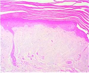 Histopathology. Note the deposition of material in the superficial dermis. Hematoxylin–eosin, ×20.