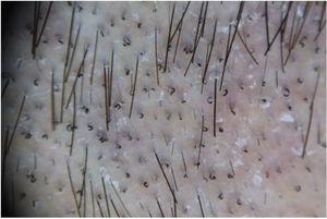 Trichoscopic image of corkscrew hairs, typical of black dot ringworm caused by T. tonsurans.